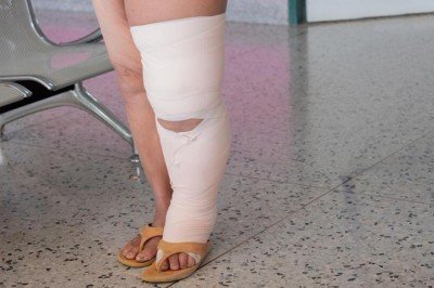 Lenfödem ve lipödem hakkında merak edilenler