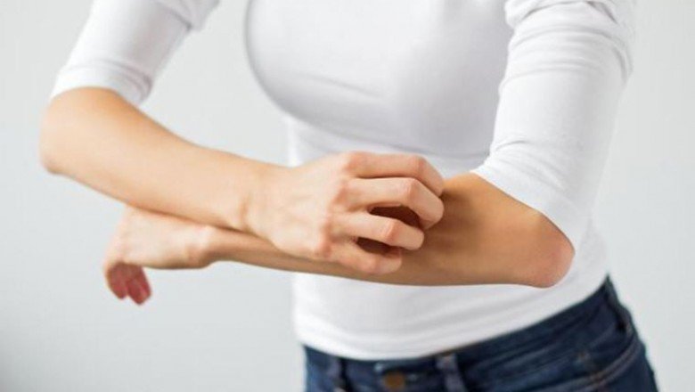 Egzama belirtilerine dikkat: Soğuk havalarda artış gösteriyor