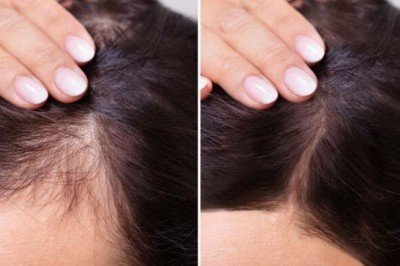 Saç dökülmesi kök hücre yöntemiyle engellenebilir