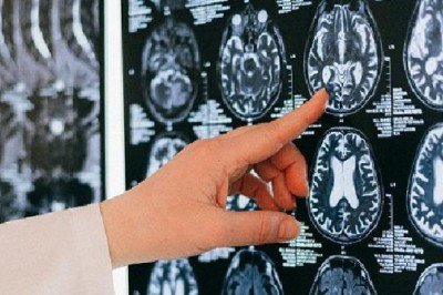 Serebral palsi; çocuklarda ilk 3 yaşa dikkat