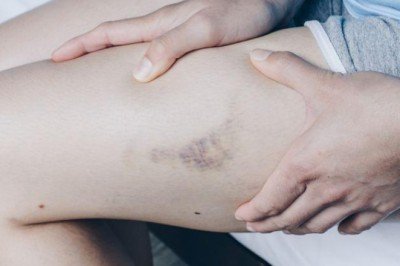 Varisler sadece estetik değil ciddiye alınması gereken bir sağlık sorunudur!