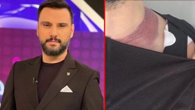 Yağ aldırma ameliyatında ölümden dönen Alişan'dan doktora rekor tazminat davası - Haberler.com