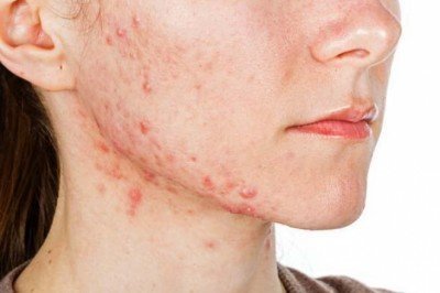 Sivilceler ruh sağlığını da etkiliyor