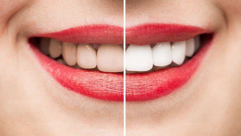 Diş beyazlatma (Bleaching) nedir?