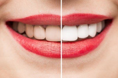 Diş beyazlatma (Bleaching) nedir?