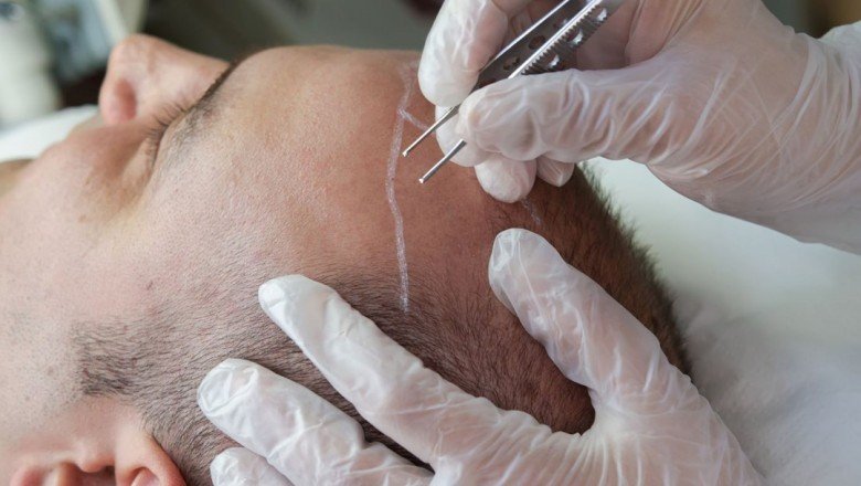 Saç ekimi nedir, nasıl yapılır?