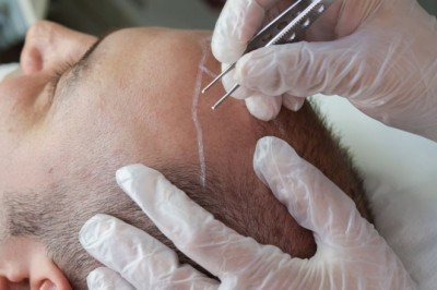 Saç ekimi nedir, nasıl yapılır?