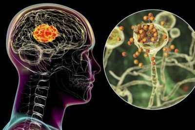 Koronavirüs beyni küçültüyor! 'Covid geçirdikten sonra mutlaka uzmana başvurun...'