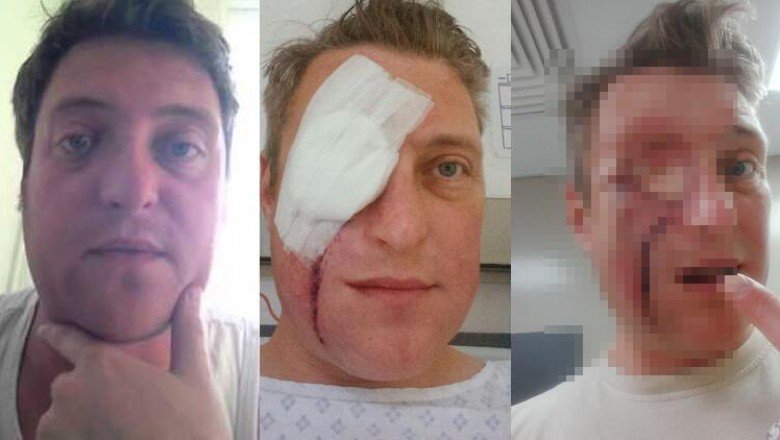 Enfeksiyon sanıldı, yüzünde dev bir delikle hastaneden ayrıldı!