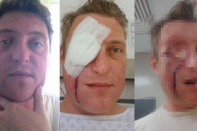 Enfeksiyon sanıldı, yüzünde dev bir delikle hastaneden ayrıldı!