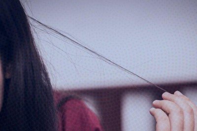 Bu hastalık saç baş yolduruyor! Karantina stresi yüzünden neredeyse kel kaldı