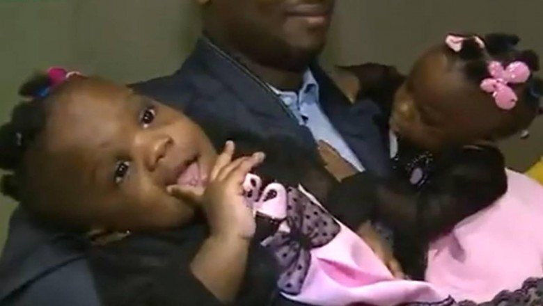 Kamerunlu siyam ikizleri İstanbulda ayrıldı