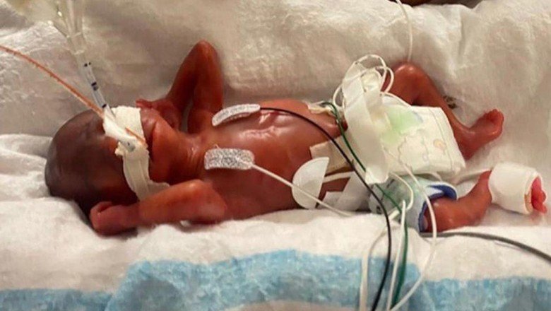 420 gram doğdu, dünyanın en prematüre bebeği oldu