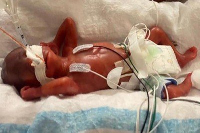 420 gram doğdu, dünyanın en prematüre bebeği oldu