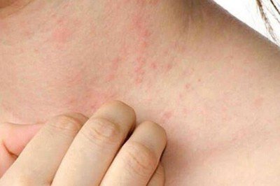 Otizm merkezinde uyuz vakası patladı