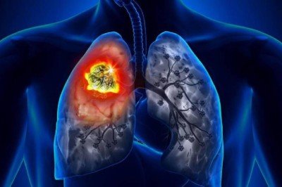 Yılda 27 binden fazla kişiye akciğer kanseri teşhisi konuluyor