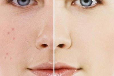 Fraksiyonel lazer nedir? Sonbahar ve Kış Cilt Bakımı