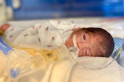 648 gram doğdu, herkese umut oldu