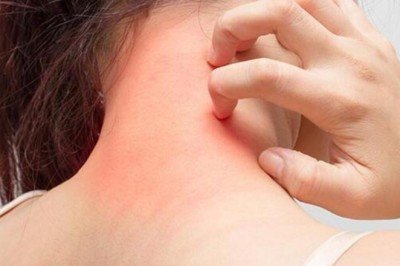 Uyuz Tedavisinde Sirke Kullanımı Nasıl Olur? Evde Uyuz Nasıl Geçer?