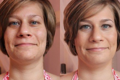 Ameliyatsız kırışıklıklarından kurtulmak mümkün mü?