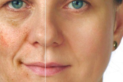 Güneş kaynaklı cilt lekelerine dikkat