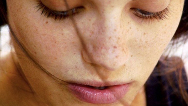 Siyah noktalardan tamamen kurtulabilirsiniz!