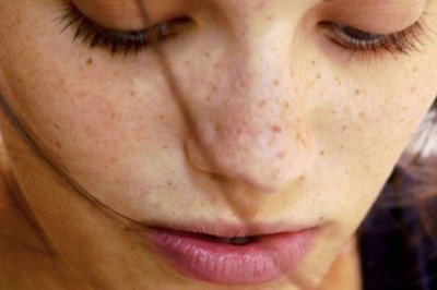 Siyah noktalardan tamamen kurtulabilirsiniz!