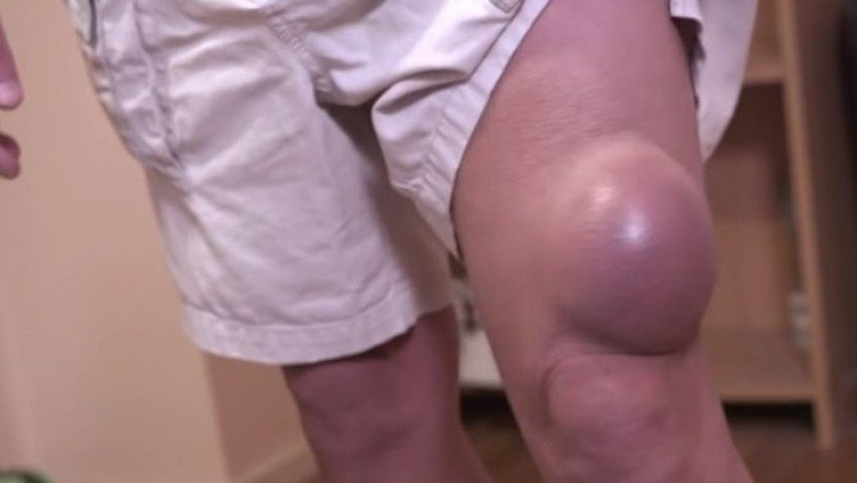 Dizindeki şişlik giderek büyüyünce doktora gitti! İçinden çıkanları doktoru bile şaşırttı