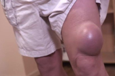 Dizindeki şişlik giderek büyüyünce doktora gitti! İçinden çıkanları doktoru bile şaşırttı