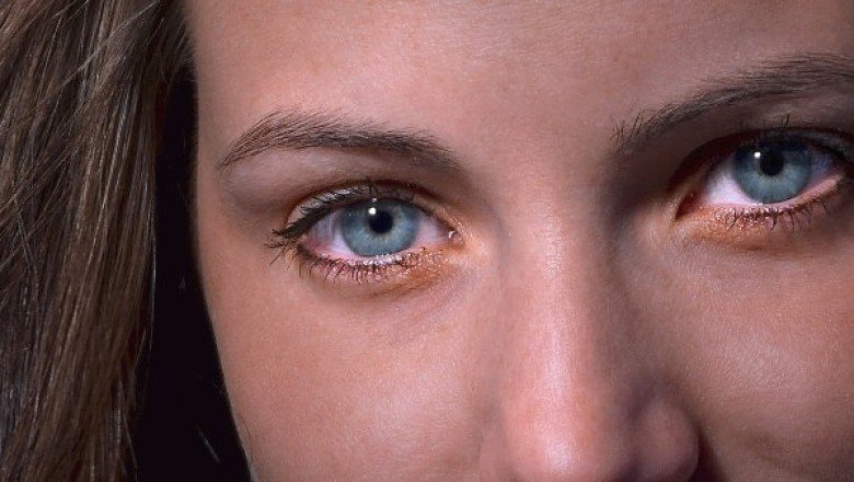 Şeffaf lens mi kullanıyorsunuz renkli lens mi?