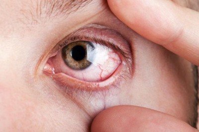 Gözler alarm veriyor: Görme kaybına yol açabilir!