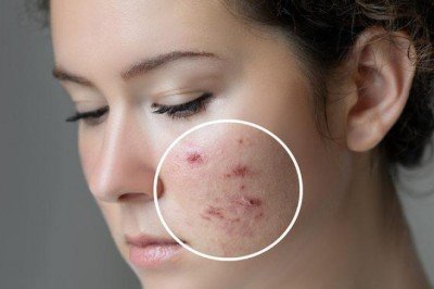 Sivilce izlerini geçirmek için yapılması gerekenler