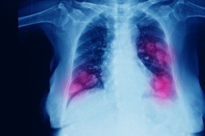 Kanserlerin yaklaşık üçte birinden sorumlu