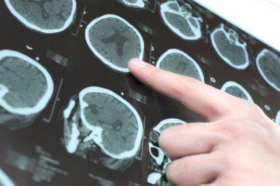 O beyin hastalığı 10 milyondan fazla insanı etkiliyor!