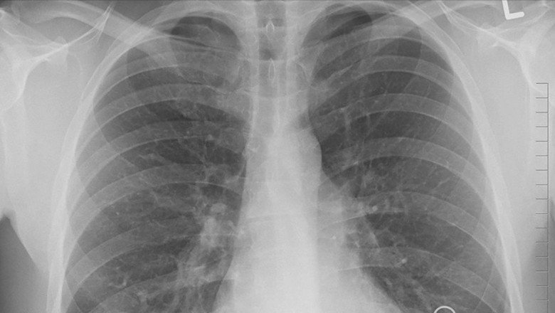 Türkiye'de yılda 35 bin kişi akciğer kanseri tanısı alıyor