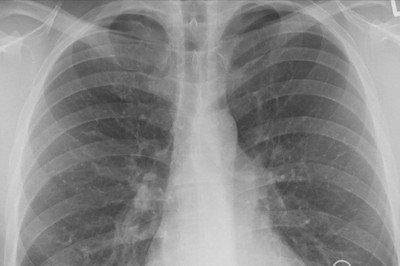 Türkiye'de yılda 35 bin kişi akciğer kanseri tanısı alıyor