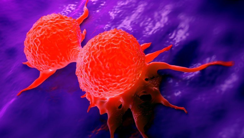 İngiltere'de meme kanseri tedavisinde 'metal dedektörü' devri