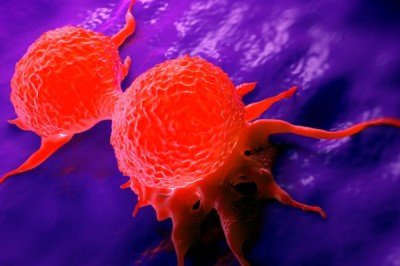 İngiltere'de meme kanseri tedavisinde 'metal dedektörü' devri