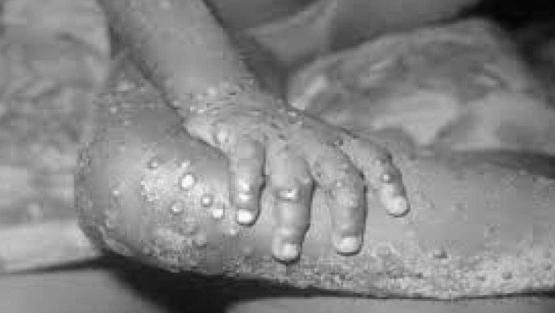 Monkeypox Virüsü Nedir? Pandemiye Dönüşür mü?