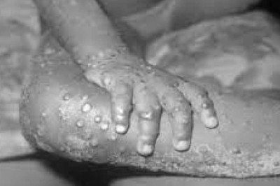 Monkeypox Virüsü Nedir? Pandemiye Dönüşür mü?