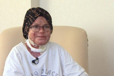 Kelebek hastası Büşra yaşadıklarını kitap haline getirdi