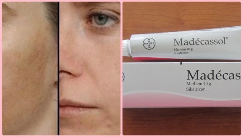 Madecassol Krem Ne İşe Yarar? Nasıl Kullanılır?