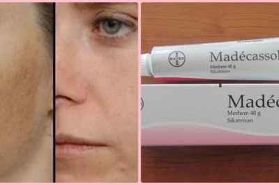 Madecassol Krem Ne İşe Yarar? Nasıl Kullanılır?