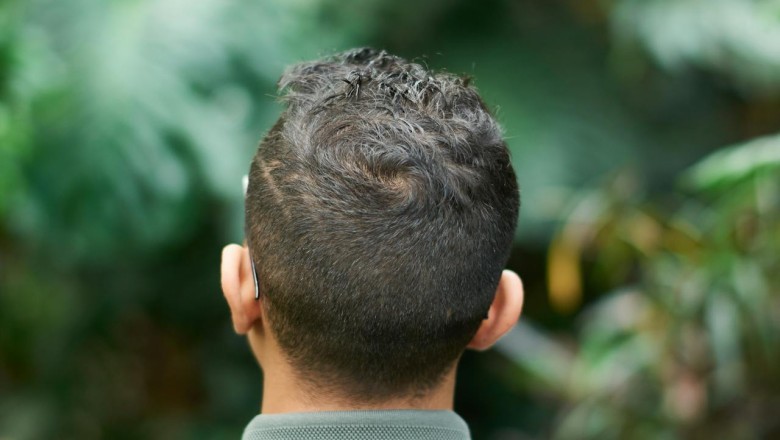 Sessiz Tetikçi DHT: Alfa-Redüktazı Kontrol Altına Almanın Güncel ve Doğal Yolları