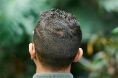 Sessiz Tetikçi DHT: Alfa-Redüktazı Kontrol Altına Almanın Güncel ve Doğal Yolları